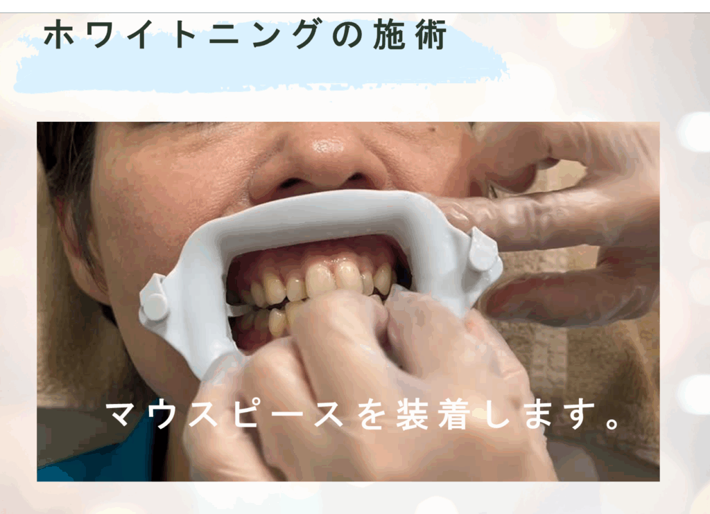 ホワイトニングの施術
マウスピースを装着します。