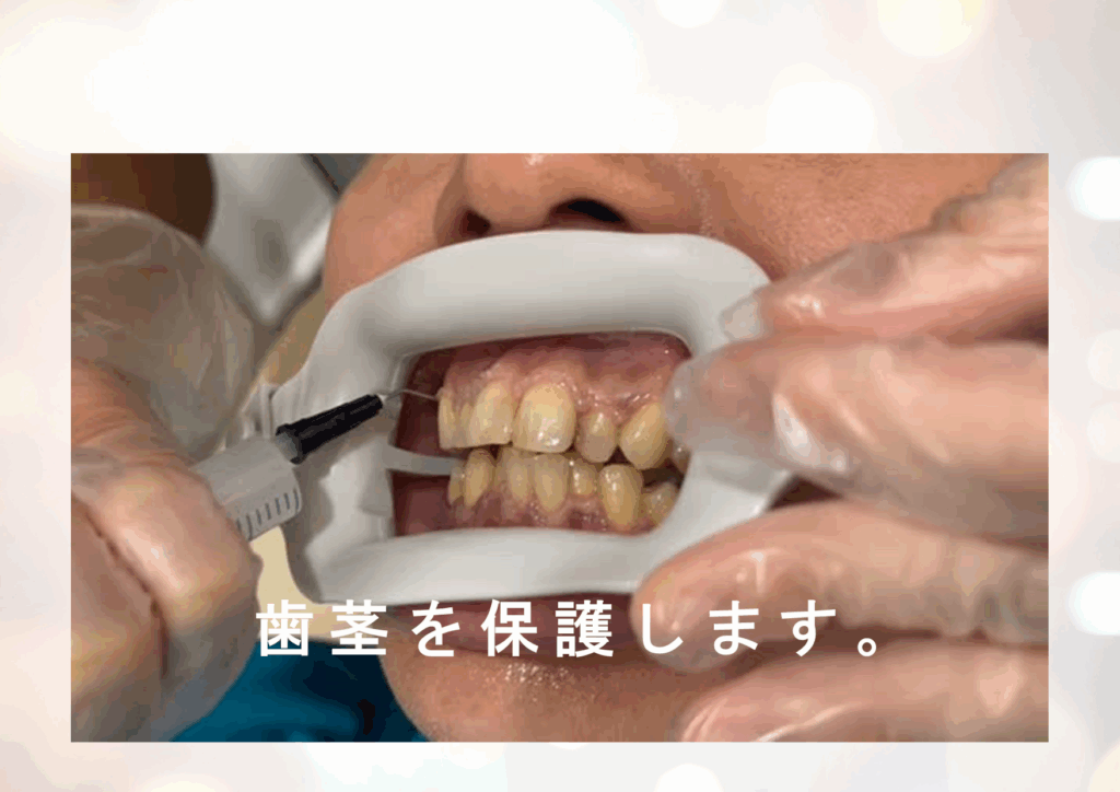 歯茎を保護します